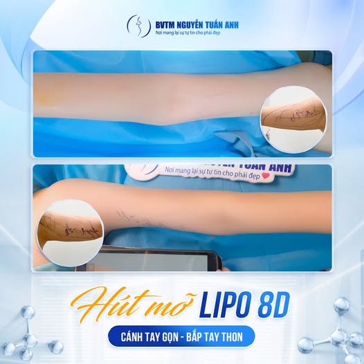 Phẫu thuật hút mỡ sau bao lâu thì sẽ hết sưng và bầm?